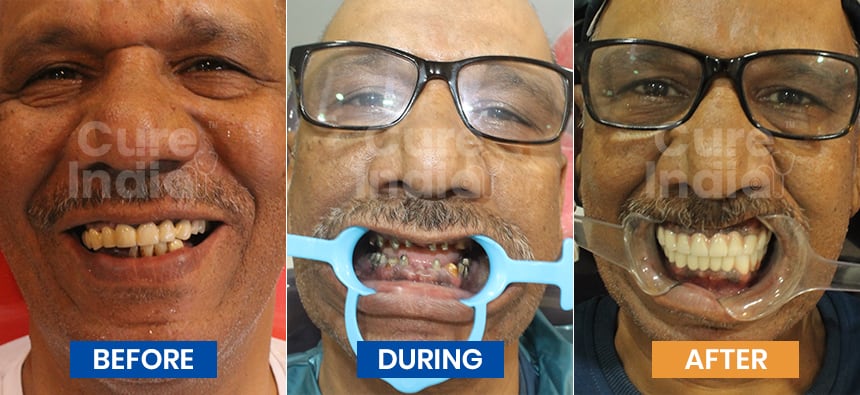 Dental Implant Before after